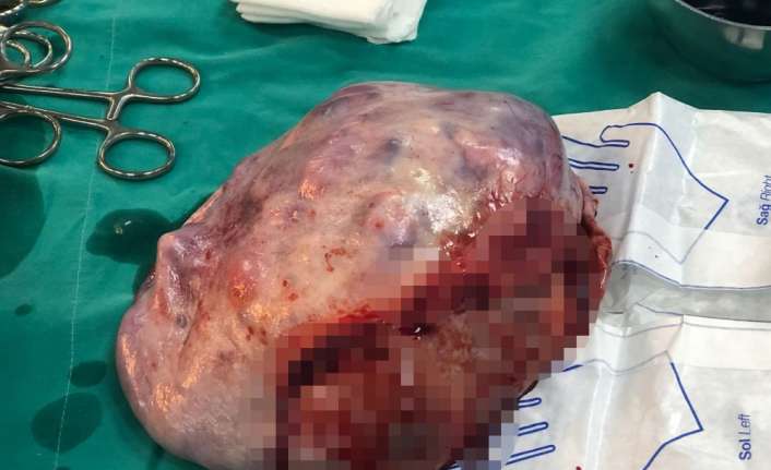 Malatya’da karın ağrısı şikayetiyle hastaneye başvuran 19 yaşındaki genç kızın