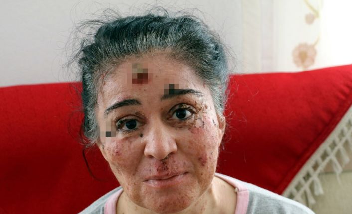 Antalya’da 8 yaşında yakalandığı deri hastalığının nadir görülen ve tedavisi