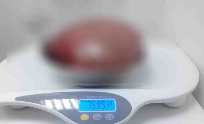 Samsun’da 38 yaşındaki bir kadının karnından 7,5 kilo ağırlığında ve