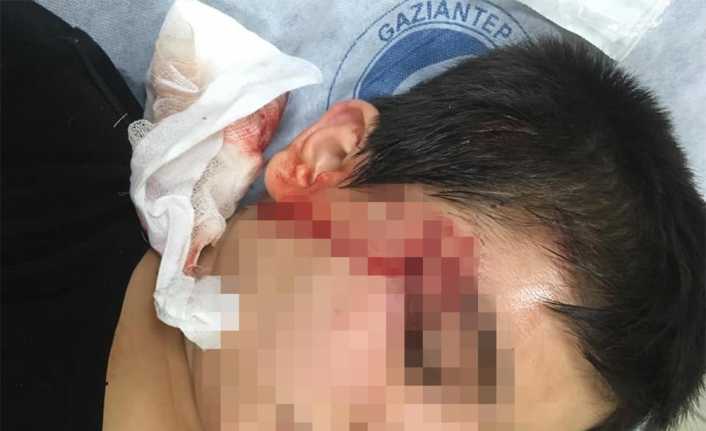 Gaziantep’te pitbull köpeğinin saldırısına uğrayan bir çocuk güçlükle kurtarıldı. Uzun
