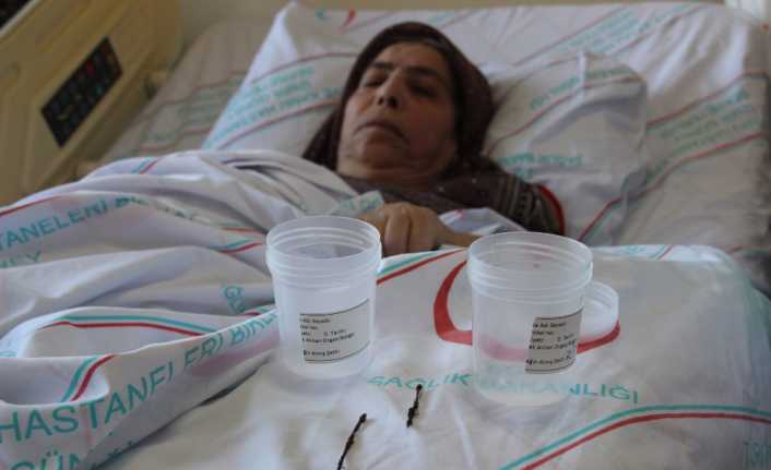 Bağırsak fistülü şikayetiyle hastaneye başvuran 68 yaşındaki kadının batın bölgesinden